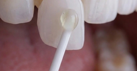 Instituto Volpe presenta Skin Finea®, carillas ultrafinas que preservan el diente propio al 100%