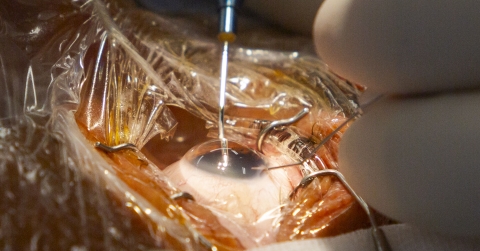 El codirector de FacoElche se somete en directo a la implantación bilateral de una lente diseñada con IA